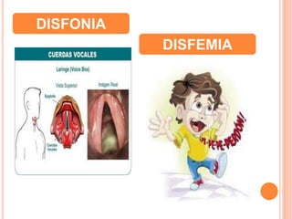 DISFONIA
DISFEMIA
 