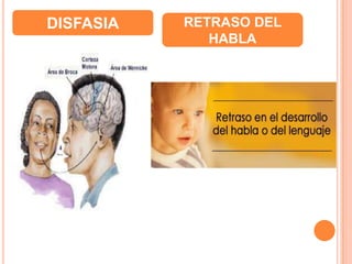 DISFASIA RETRASO DEL
HABLA
 