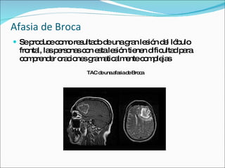 Afasia de Broca Se produce como resultado de una gran lesión del lóbulo frontal, las personas con esta lesión tienen dificultad para comprender oraciones gramaticalmente complejas TAC de una afasia de Broca 