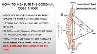 Lenke Classification Chart Lenke Classification for Adolescent Idiopathic Scoliosis (AIS) | PPTX