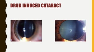 DRUG INDUCED CATARACT
 