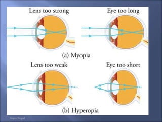 Lenses and defects of vision Light chapter for SEE Nepal | PDF