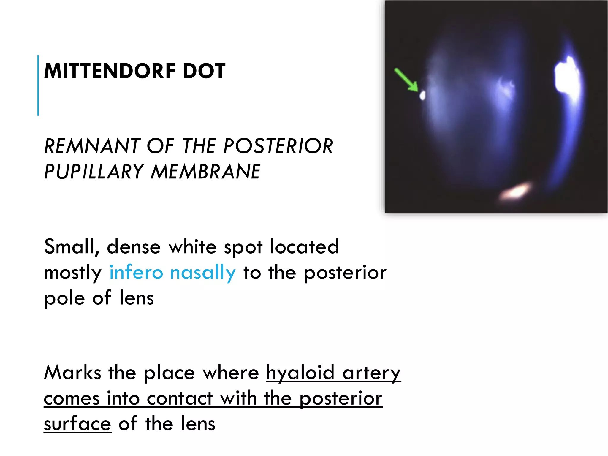 Crystalline Lens | PDF