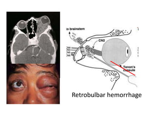 Retrobulbar hemorrhage
 