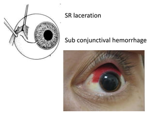 SR laceration
Sub conjunctival hemorrhage
 