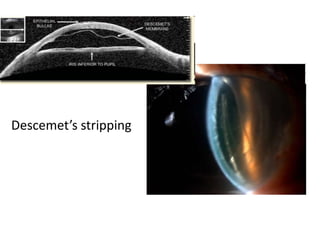 Descemet’s stripping
 