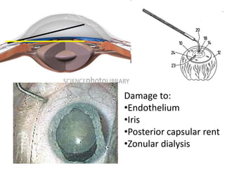 Damage to:
•Endothelium
•Iris
•Posterior capsular rent
•Zonular dialysis
 