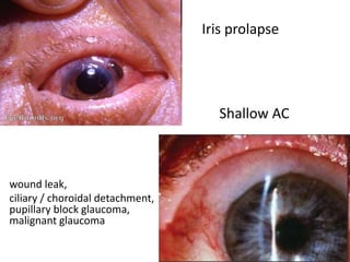 wound leak,
ciliary / choroidal detachment,
pupillary block glaucoma,
malignant glaucoma
Iris prolapse
Shallow AC
 