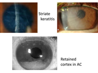 Striate
keratitis
Retained
cortex in AC
 