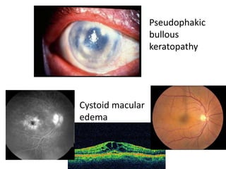 Pseudophakic
bullous
keratopathy
Cystoid macular
edema
 
