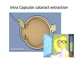 Intra Capsular cataract extraction
 