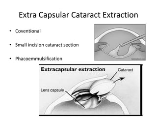 Extra Capsular Cataract Extraction
• Coventional
• Small incision cataract section
• Phacoemmulsification
 