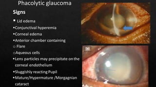 Lens induced glaucoma - DR ARNAV | PPT