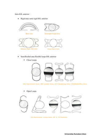 Iol Consignment Open Rack LENSA INTRA OKULER 2.pdf