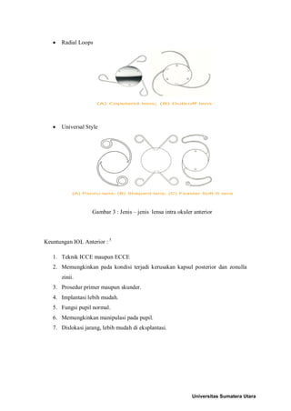  Radial Loops
 Universal Style
Gambar 3 : Jenis – jenis lensa intra okuler anterior
Keuntungan IOL Anterior : 5
1. Teknik ICCE maupun ECCE
2. Memungkinkan pada kondisi terjadi kerusakan kapsul posterior dan zonulla
zinii.
3. Prosedur primer maupun skunder.
4. Implantasi lebih mudah.
5. Fungsi pupil normal.
6. Memungkinkan manipulasi pada pupil.
7. Dislokasi jarang, lebih mudah di eksplantasi.
Universitas Sumatera Utara
 