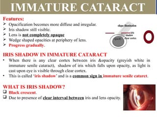 immature senile cataract iris shadow Images High... Lens and Cataract.HYKULIO;PO[PGTJUO,OL0,M | PPTX