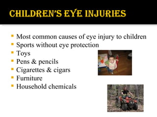 Most common causes of eye injury to children Sports without eye protection Toys Pens & pencils Cigarettes & cigars Furniture Household chemicals 
