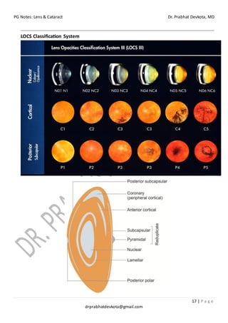 PG Notes: Lens & Cataract Dr. Prabhat Devkota, MD
17 | P a g e
drprabhatdevkota@gmail.com
LOCS Classification System
 