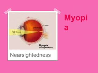 Myopi
a
Nearsightedness
 