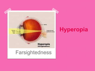 Hyperopia
Farsightedness
 
