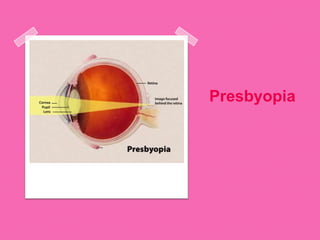 Presbyopia
 