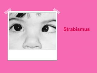 Strabismus
 