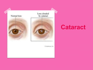 Cataract
 