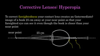 Corrective Lenses: Hyperopia
To correct farsightedness your contact lens creates an (intermediate)
image of a book 25 cm away at your near point so that your
farsighted eye can see it even though the book is closer than your
near point
25 cmnear point
 