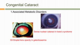 Anatomy and physiology of lens | PPTX