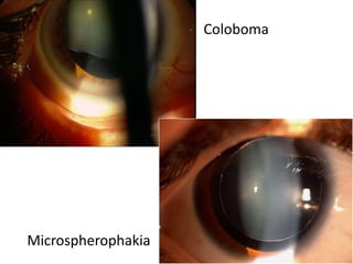 Microspherophakia
Coloboma
 