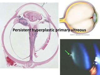 Persistent hyperplastic primary vitreous
 
