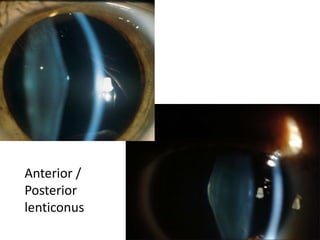Anterior /
Posterior
lenticonus
 