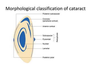 Morphological classification of cataract
 