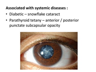 Associated with systemic diseases :
• Diabetic – snowflake cataract
• Parathyroid tetany – anterior / posterior
punctate subcapsular opacity
 