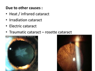 Due to other causes :
• Heat / infrared cataract
• Irradiation cataract
• Electric cataract
• Traumatic cataract – rosette cataract
 