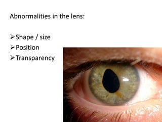 Abnormalities in the lens:
Shape / size
Position
Transparency
 