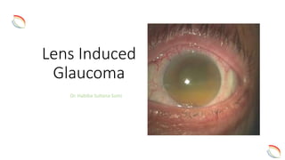 Lens Induced
Glaucoma
Dr. Habiba Sultana Sumi
 