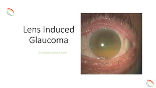 Lens induced glaucoma. | PPT