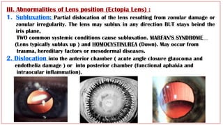 Sublux Ex Lens lecture revision Arab Board HUCOM.pptx