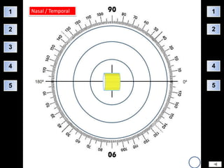 1   Nasal / Temporal   1

2                      2

3


4                      4


5                      5
 