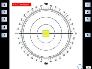 1   Nasal / Temporal   1

2                      2

3                      3


4


5                      5
 