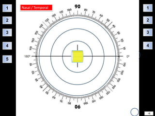1   Nasal / Temporal   1

2                      2

3                      3


4                      4


5
 