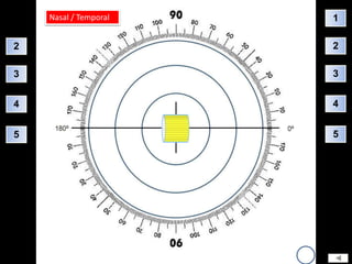Nasal / Temporal   1

2                      2

3                      3


4                      4


5                      5
 