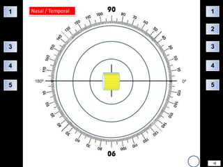 1   Nasal / Temporal   1

                       2

3                      3


4                      4


5                      5
 