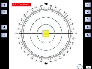 1   Nasal / Temporal   1

2                      2

                       3


4                      4


5                      5
 
