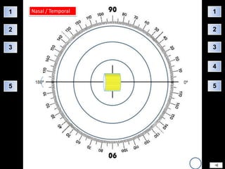 1   Nasal / Temporal   1

2                      2

3                      3


                       4


5                      5
 