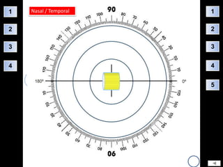 1   Nasal / Temporal   1

2                      2

3                      3


4                      4


                       5
 