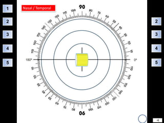 1   Nasal / Temporal


2                      2

3                      3


4                      4


5                      5
 