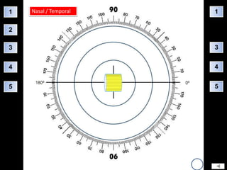 1   Nasal / Temporal   1

2

3                      3


4                      4


5                      5
 