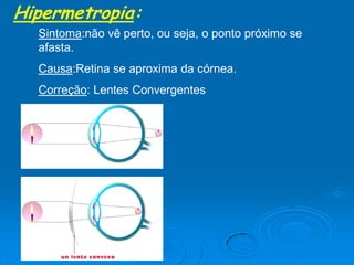 Hipermetropia:
Sintoma:não vê perto, ou seja, o ponto próximo se
afasta.
Causa:Retina se aproxima da córnea.
Correção: Lentes Convergentes
 